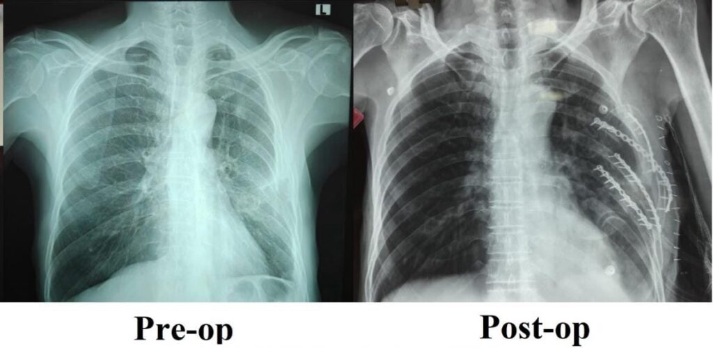 SRM Medical College Hospital and Research Centre Performs Its First Rib Stabilisation Surgery